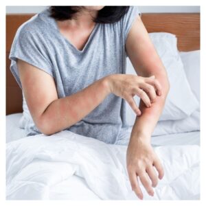 bed bug bite